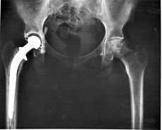 Hip Replacement (via Wikipedia)